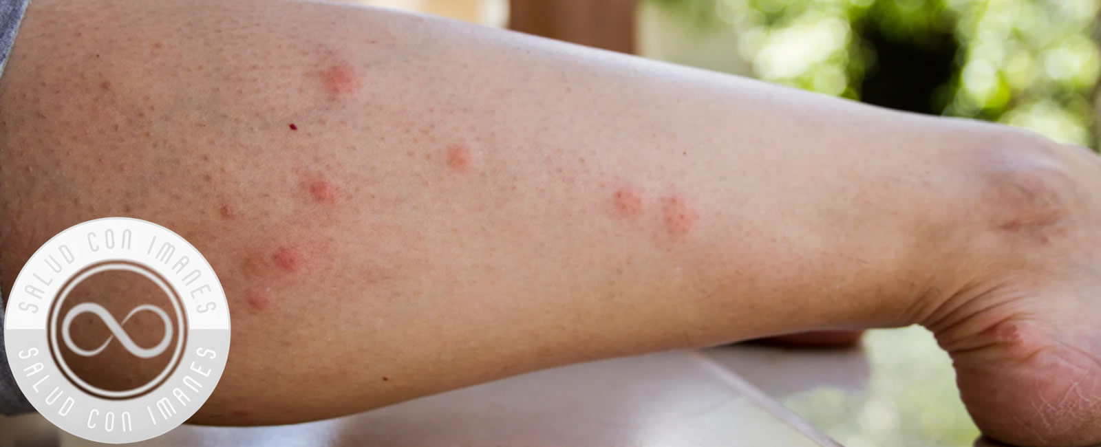 tratamiento infecciones mosquitos par biomagnetico