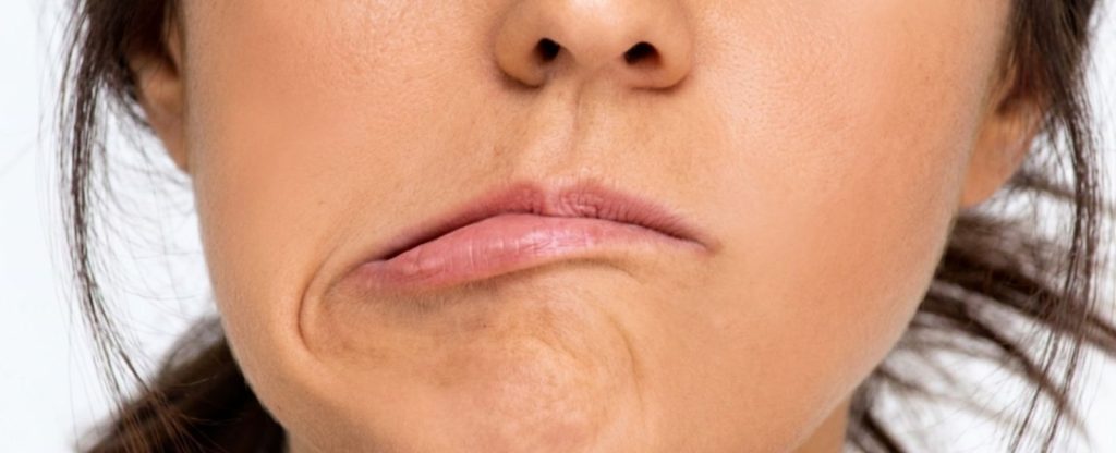 paralisis facial Emilia Bermejo